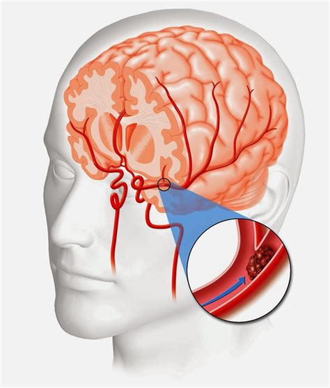 o acidente vascular encefálico esta interligado ao fluxo sanguíneo cerebral. ele pode ser caracteriz